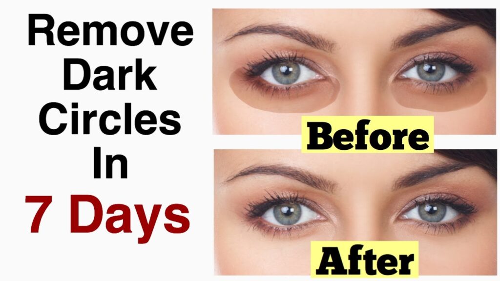 How To Remove Dark Circles: The Simple, Natural Way (काले घेरे हटायें ...